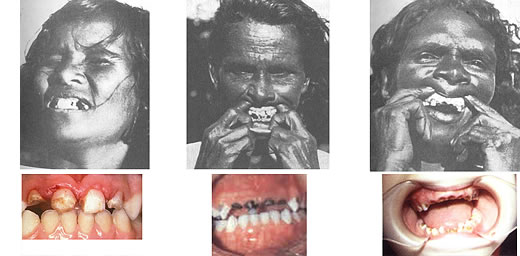 Aboriginal tooth decay